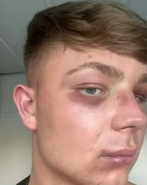 Νεαρός ξυλοκοπημένος άγρια στη Ζάκυνθο: Η εκδοχή του